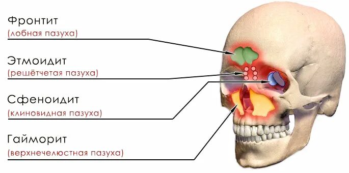 Синусит верхнечелюстной пазухи. Фронтит воспаление лобной пазухи. Фронтит трепанопункция лобной пазухи. Гайморовы и лобные пазухи.