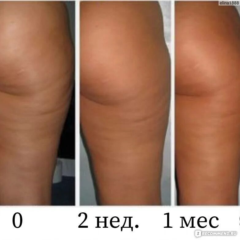 Сколько нужно сеансов антицеллюлитного массажа