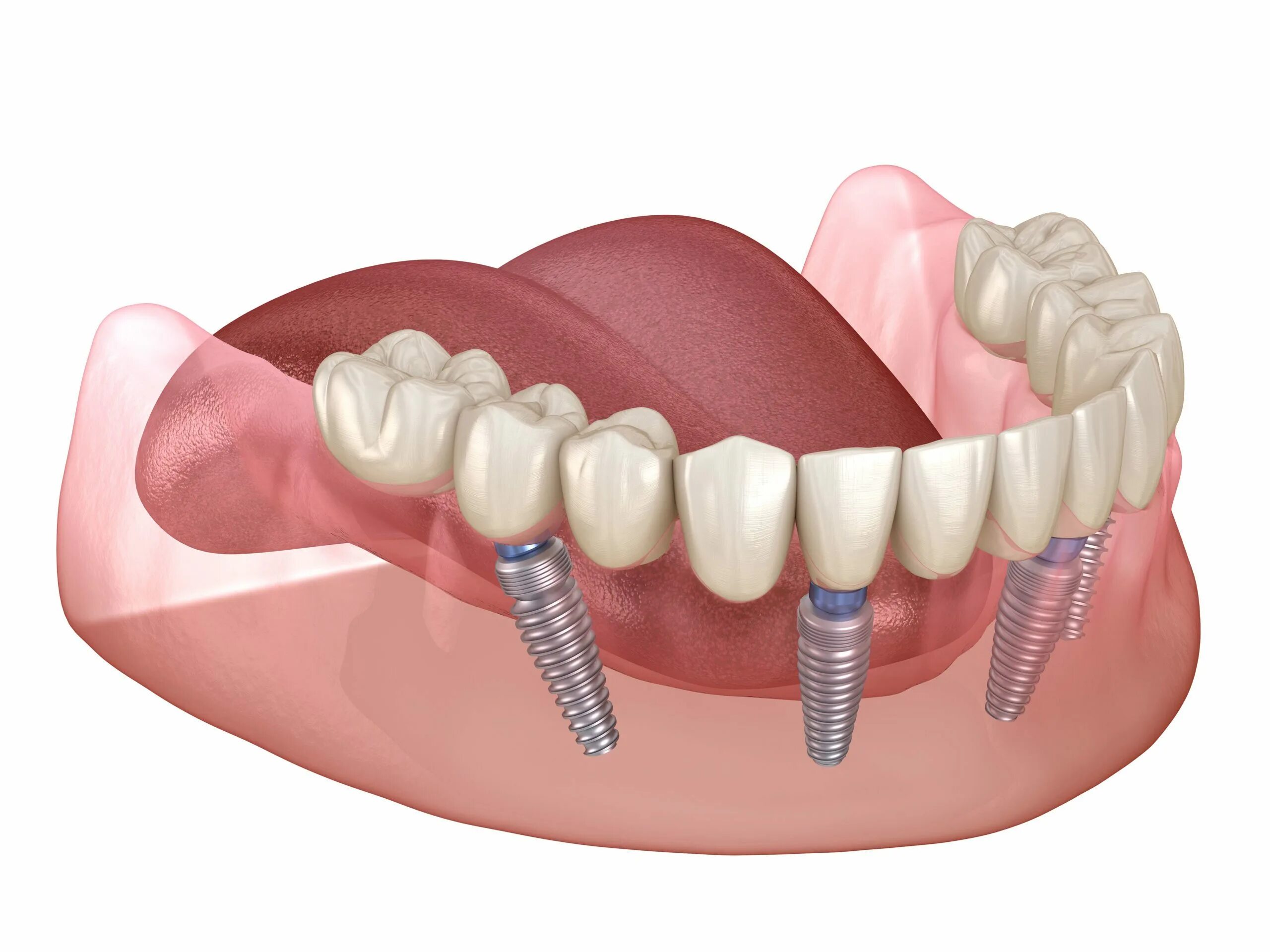 Имплантация зубов по технологии «all on 4» верхней. Ab Dental имплантаты. Имплантация Neodent. Имплантация зубов all on 6