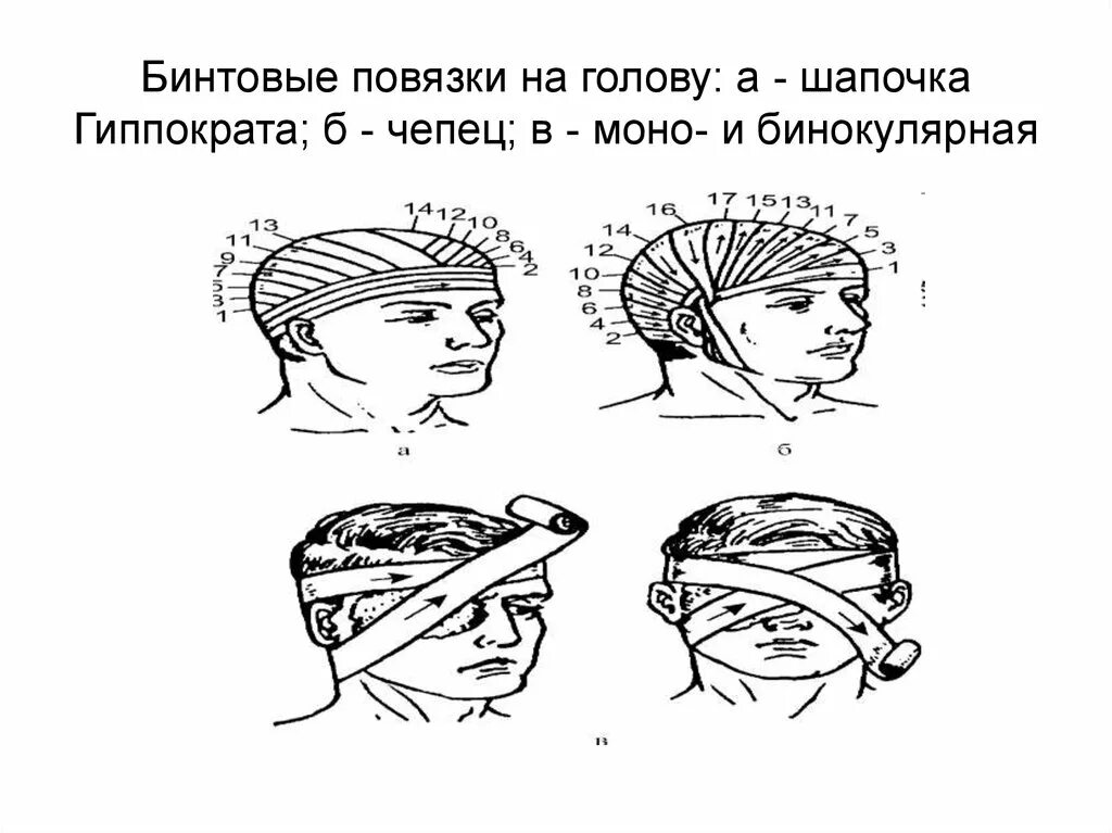 Повязка на голову размеры. Десмургия шапочка ЧЕПЕПЕЦ. Десмургия повязка чепец. Чепец и шапочка Гиппократа. Бинтовая повязка шапочка Гиппократа.