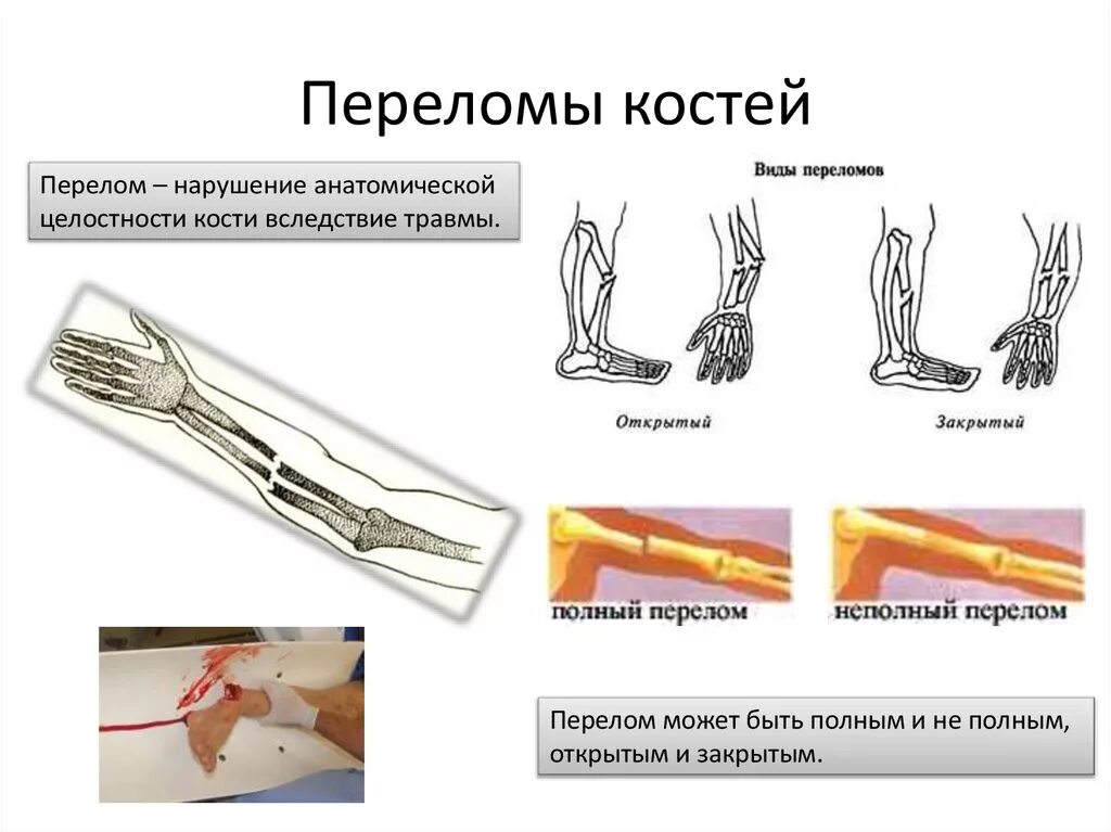 Какой вид травмы показан на рисунке. Нарушение целостности костей.