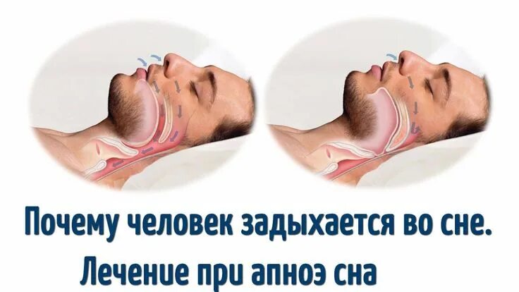 Во время сна начинаю задыхаться