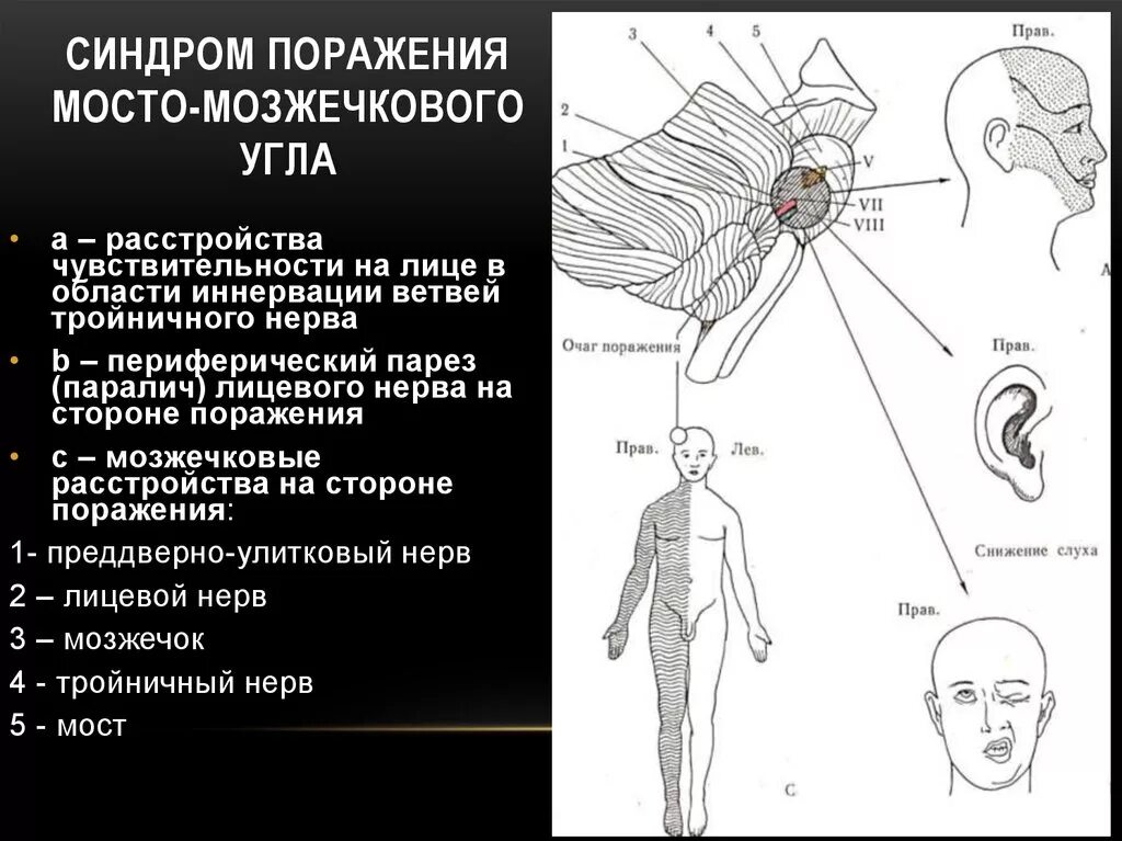 Поражение двигательного нерва. Синдром поражения нервов мосто-мозжечкового угла неврология. Синдром мостомозжечкового угла симптомы. Поражение ядра тройничного нерва. Синдром поражения структур мосто-мозжечкового угла..