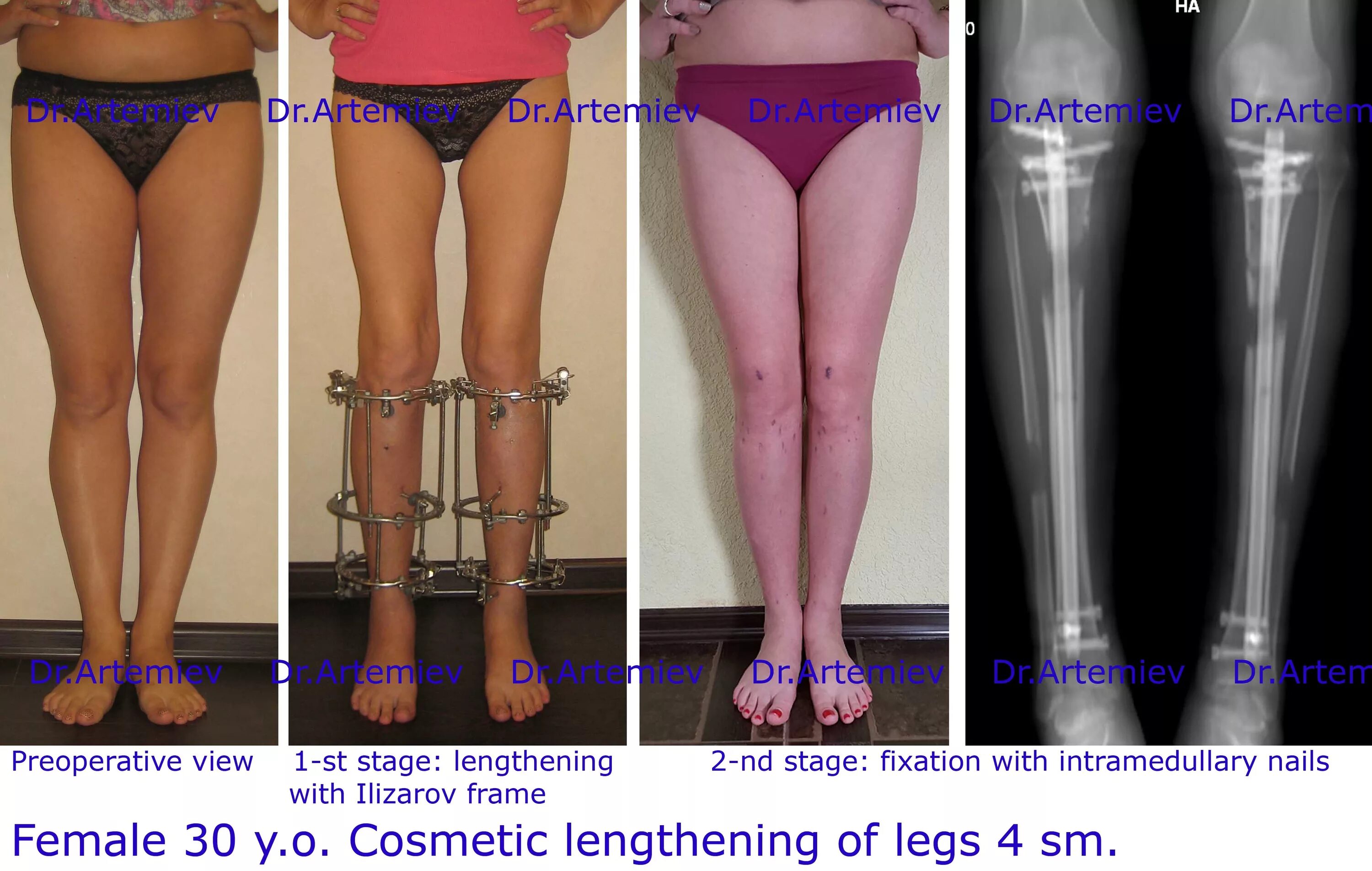 Удлиняют ли ноги. Аппарат Илизарова на голень. Удлинение ног аппаратом Илизарова. Аппарат Илизарова таз бедро. Аппарат Илизарова удлинение конечности.
