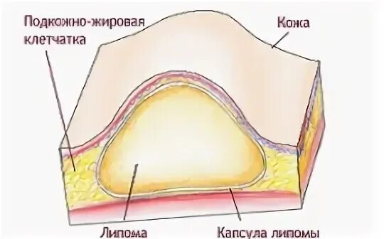 Как выглядит липома на ноге Фотографии ОПУХОЛЬ ЖИРОВОЙ ТКАНИ