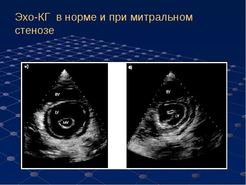 Дегенерация митрального клапана. Нормальный митральный клапан на ЭХОКГ. Створки митрального клапана на Эхо. Митральный вальвулит эхокардиография. Створки аортального клапана вегетации ЭХОКГ.