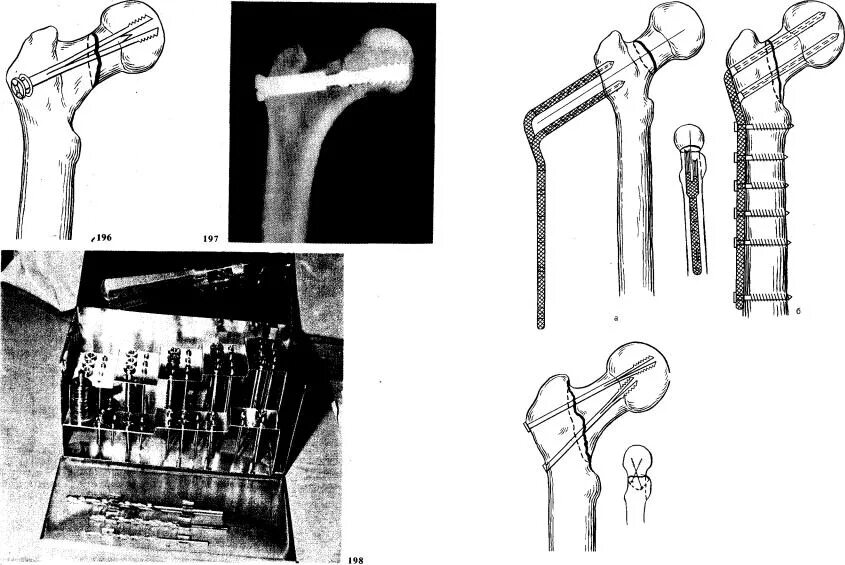 Операция остеосинтез шейки бедра. Перелом шейки бедра остеосинтез рентген. Перелом шейки бедра остеосинтез. Перелом бедра остеосинтез. Остеосинтез при переломе шейки бедренной кости.