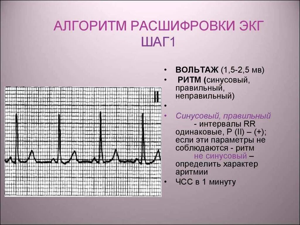 На графике изображена электрокардиограмма