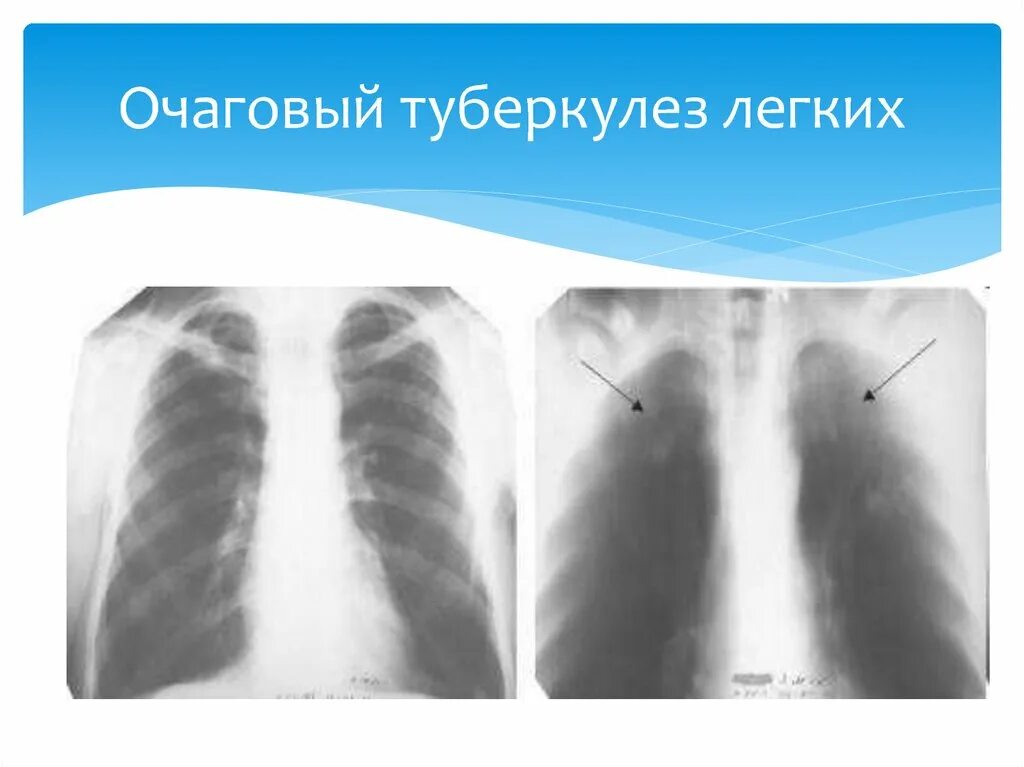 Очаговый туберкулез диагностика фтизиатрия. Очаговая форма туберкулеза рентген. Очаговый туберкулез легких. Очаговый туберкулёз лёгких. Фазы очагового туберкулеза