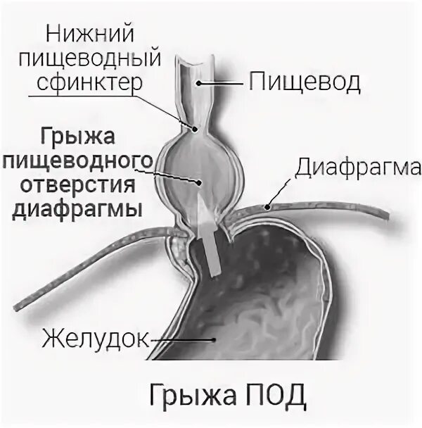 Грыжа пищевода отзывы пациентов. Аксиальная грыжа пищеводного отверстия диафрагмы. Грыжа диафрагмального отверстия пищевода рентген. Грыжа диафрагмы пищеводного 1 степени. Грыжа пищеводного отверстия диафрагмы клинические рекомендации 2022.