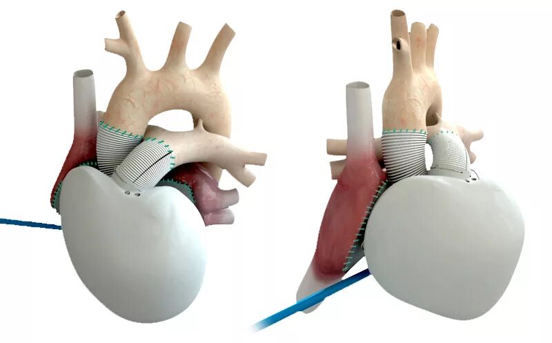 протез аортального клапана. искусственное сердце протез. искусственное сердце cardiowest. имплант искусственного сердца герц-02. искусственное сердце из полимеров.