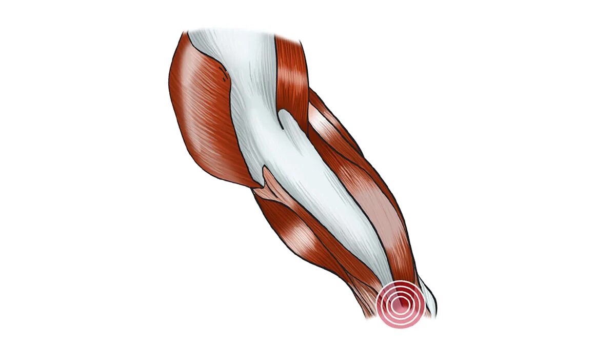 Укороченное сухожилие. Тендинит сухожилия двуглавой мышцы. Тендинит двуглавой мышцы локтя. Тендинит сухожилия бицепса. Тендинит коленного сустава.