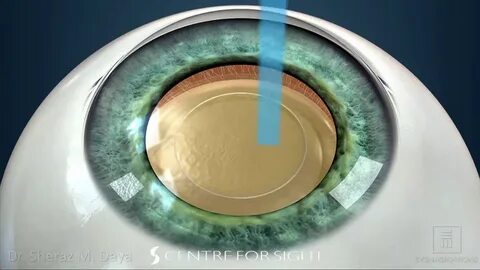 Cataract