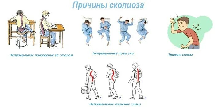 Сколиоз зрение. Памятка искривление позвоночника. причины сколиоза. причины возникновения искривления позвоночника. причины сколиоза у детей.