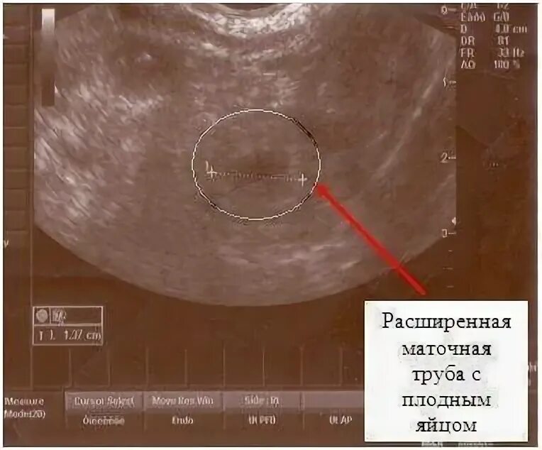 Маточная беременность на УЗИ на раннем сроке. Внематочная Трубная беременность УЗИ. УЗИ на 4 неделе внематочная бер. УЗИ матки на первых неделях беременности. На узи видно месячные