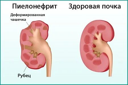 Пиелонефрит осложнения