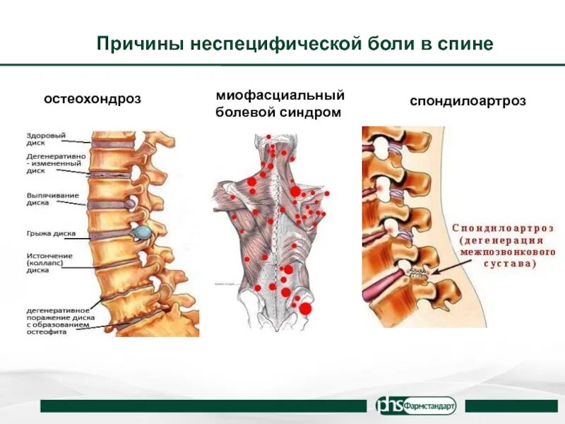 Грыжа дисков спондилоартроз. Неспецифическая боль в спине. неспецифические скелетно-мышечные боли в спине. причины неспецифической боли в спине. остеохондроз спондилоартроз.