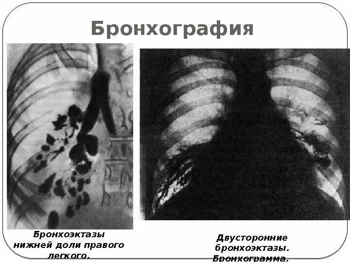 Боли в нижней доле легких. Бронхография бронхоэктазы. Бронхиолоэктатическая эмфизема Лешке. Бронхография патология.