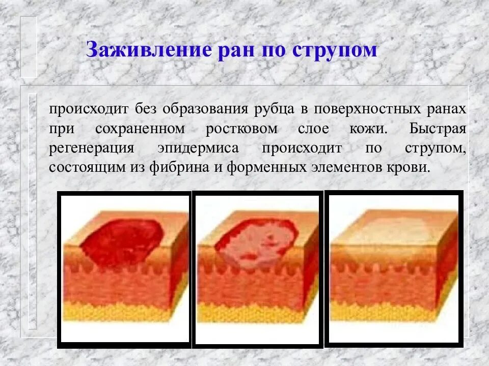 Слизистые покровы или гладкая поверхность мелкие. Заживление РАН грануляционная ткань. Грануляционная ткань в рубцовую. Процесс заживления РАН схема. Фаза эпителизации и грануляции раны.