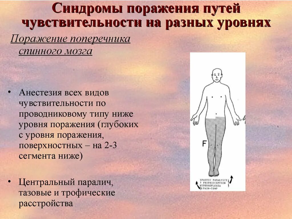 Типы поражения чувствительности. Синдромы поражения чувствительности. Поражение чувствительности на разных уровнях. Нарушения чувствительности на различных уровнях. Синдромы расстройств чувствительности.