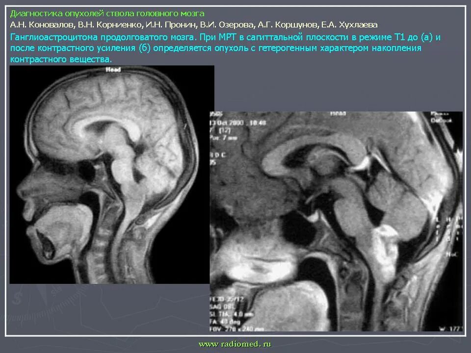 Рак ствола головного мозга. Диффузная опухоль ствола головного мозга. Кт ГМ отек головного мозга. Глиома продолговатого мозга мрт. Глиома ствола головного мозга.