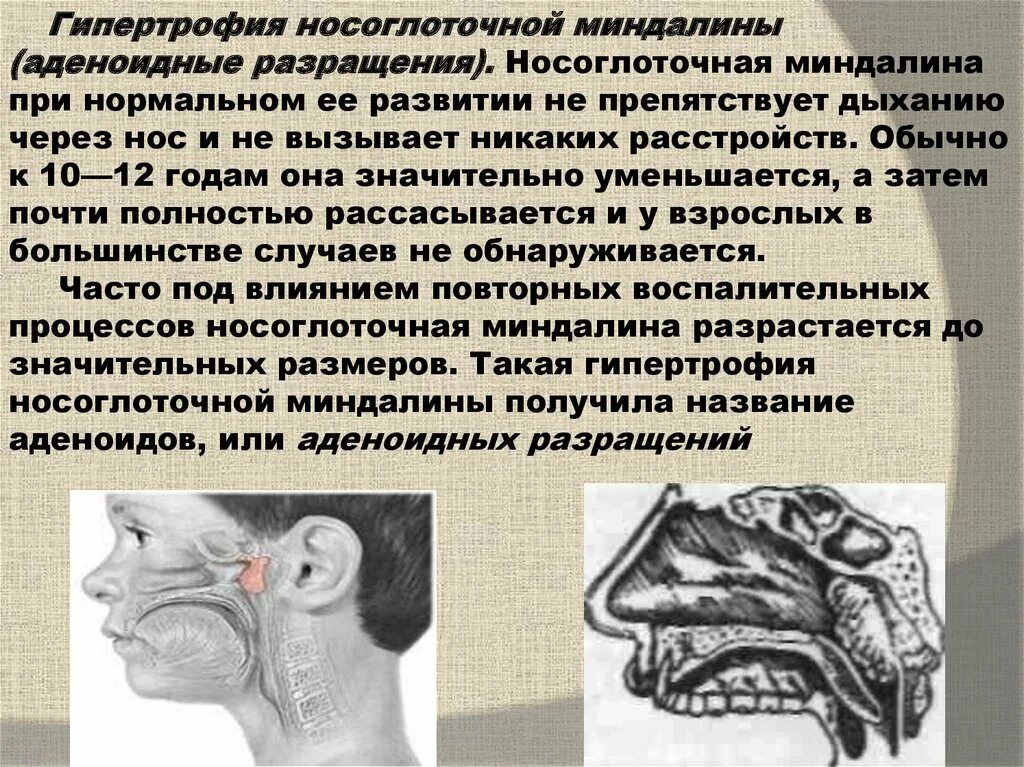 Гипертрофия носа. Разрастание носоглоточной миндалины. степени развития аденоидов. гипертрофия небных миндалин. гипертрофия миндалин с гипертрофией аденоидов.