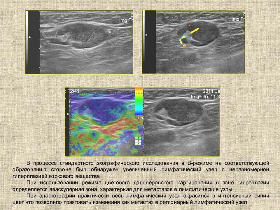 Обследование при увеличении лимфатических узлов. Узи анатомия лимфатических узлов. строение лимфоузла на узи норма. строение лимфатического узла на узи. узи заушных лимфатических узлов.