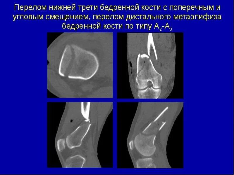 Перелом дистального метаэпифиза плечевой кости. Перелом со смещением н/3 бедра. Перелом диафиза бедренной кости рентген. Перелом нижней трети диафиза правой бедренной кости. Перелом н 3