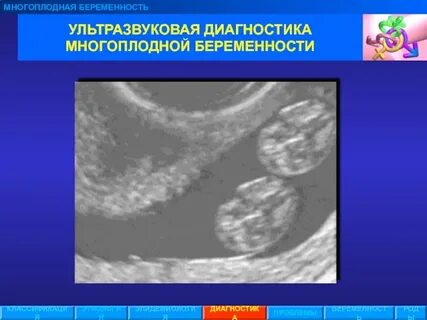 Классификация многоплодной беременности