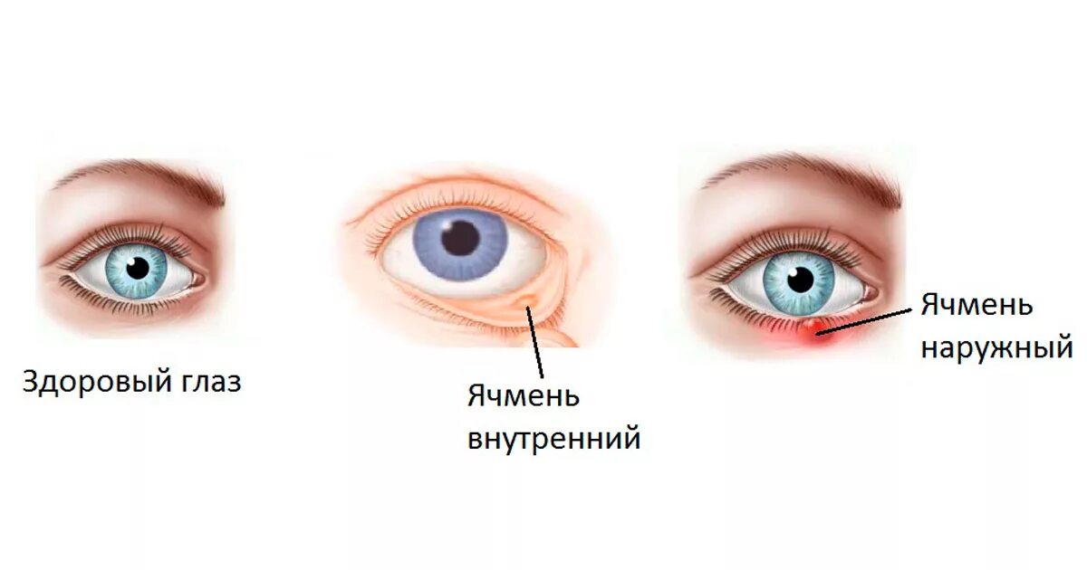 Можно ли лечить ячмень. Ячмень заболевание глаз. Внутренний ячмень на глазу.