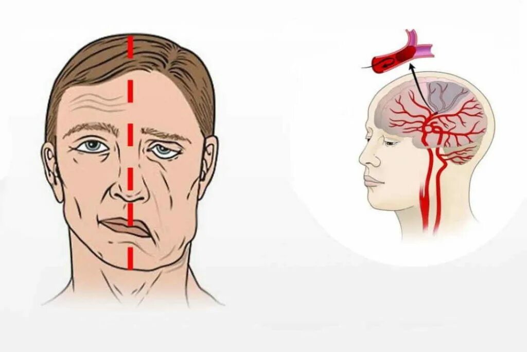 Признаки головного инсульта. Инсульт картинки. Ишемический инсульт картинки. Исудьт.