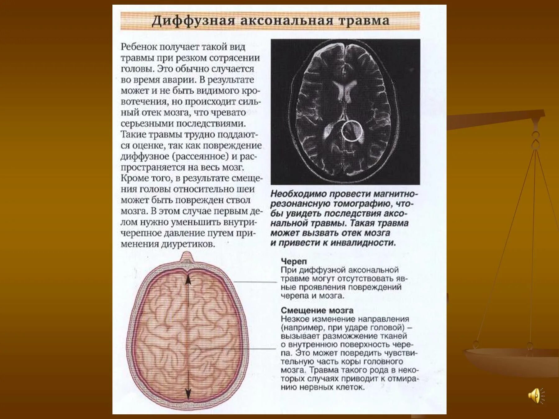 Диффузное аксональное повреждение. Диффузное аксональное повреждение мозга. Диффузно аксональная травма головы. Диффузная травма ноловного могза.