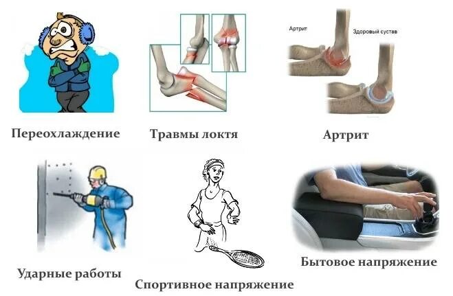 Защемление локтевого сустава. Ущемление локтевого нерва локтевого сустава. защемление нерва в локте.