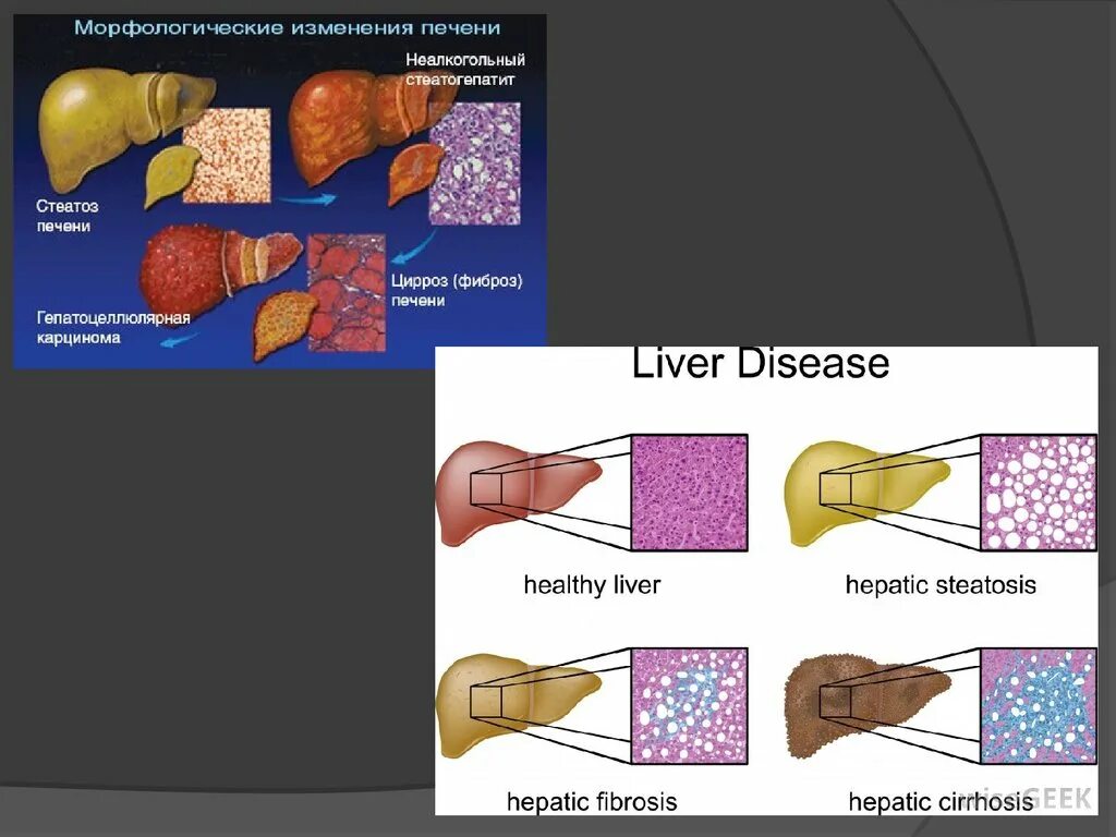 Признаки стеатоза печени. Неалкогольный стеатоз печени. Гепатолиенальный синдром. Патогенез стеатогепатита.