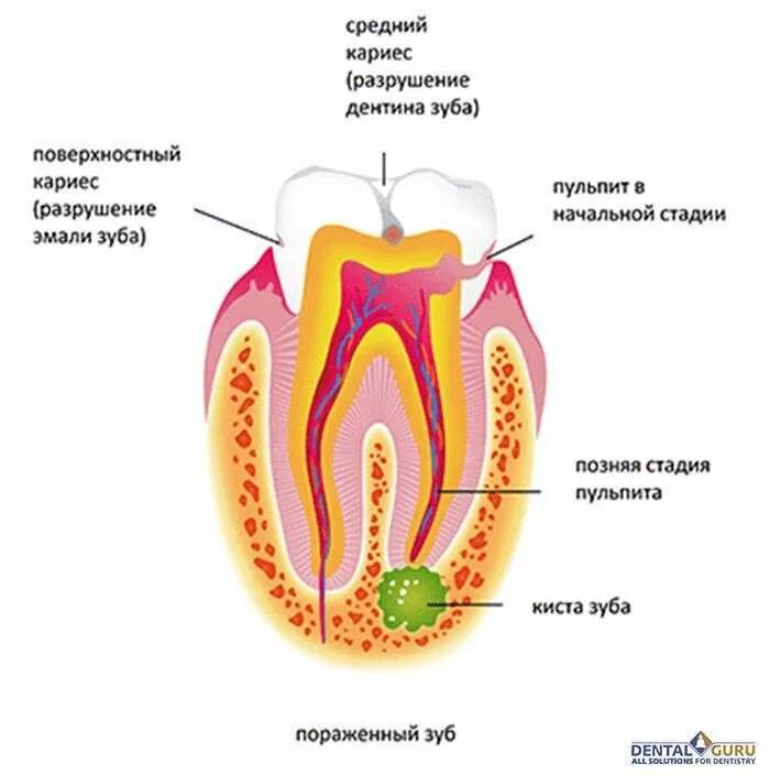 Киста зуба что это. Образование корня зуба.