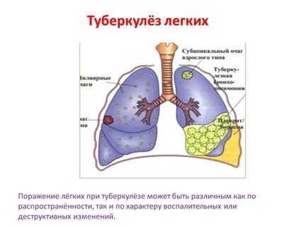 Анатомия туберкулеза