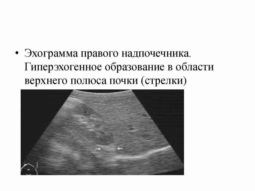 Гиперэхогенное образование. Гиперэхогенные структуры на УЗИ. Верхний полюс левой почки на УЗИ. Гиперэхогенные образования в почках. Верхний полюс правой почки на УЗИ.