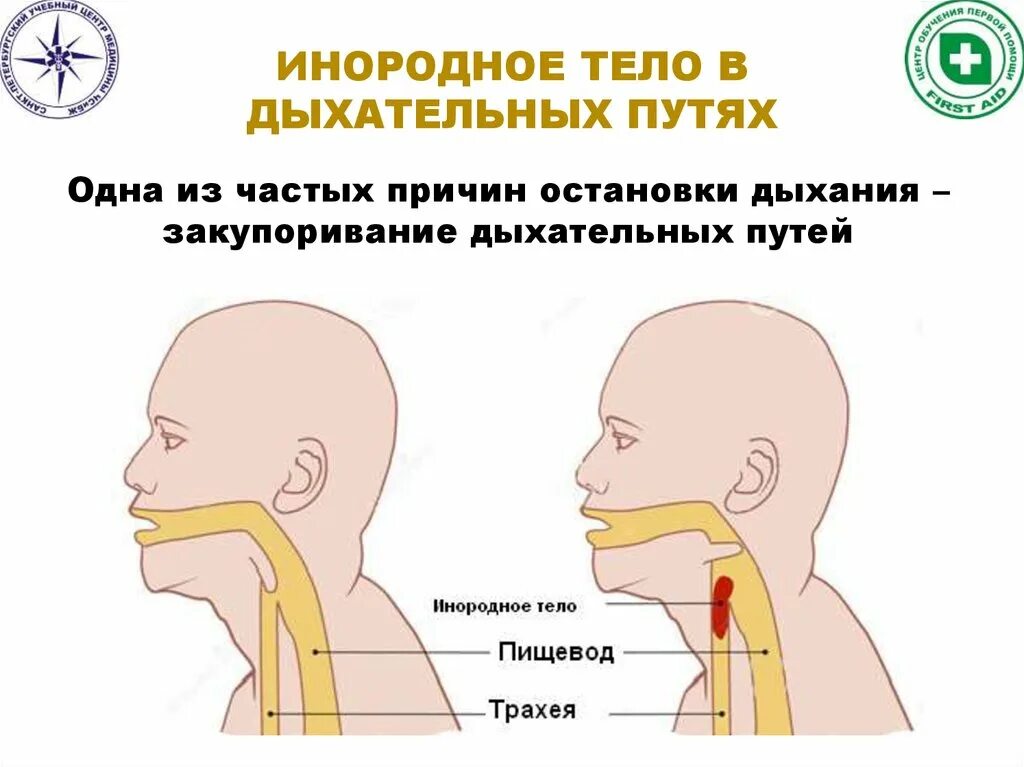 При глотании ощущение инородного. Таблетка попала в дыхательные пути симптомы. Если еда попала в дыхательные пути. Дыхательные пути в горле. Таблетки для дыхательных путей.