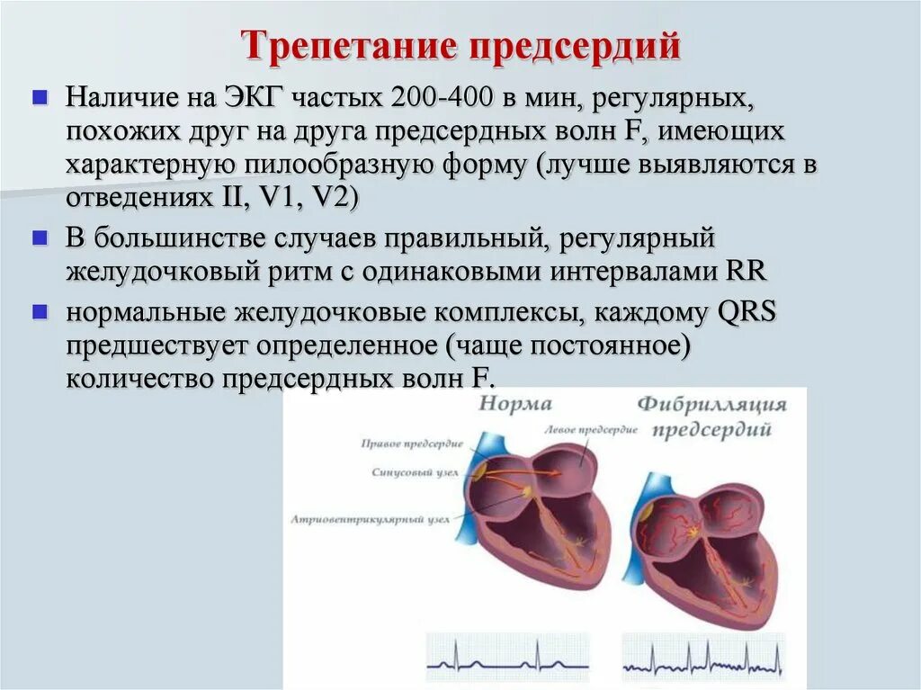 Предсердие болезни. Формы фибрилляции предсердий ЭКГ. Трепетание предсердий атипичная форма на ЭКГ. Трепетание предсердий на ЭКГ. Правильная форма трепетания предсердий на ЭКГ.