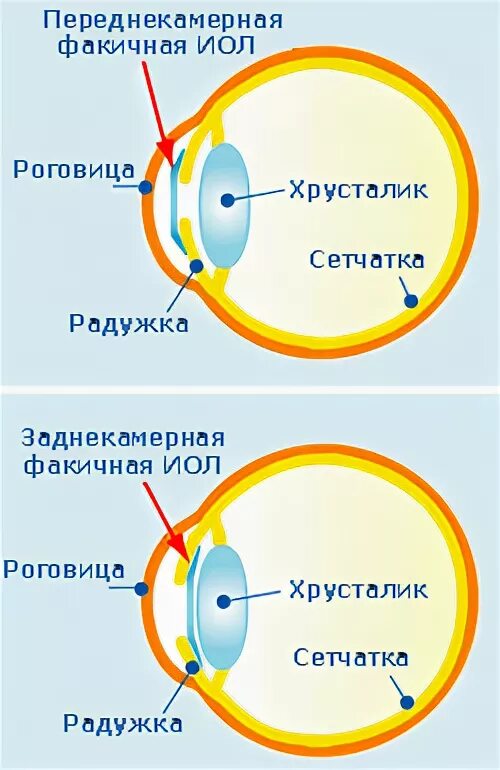 Строение глаза роговица хрусталик. Глаз хрусталик ставить. Строение глаза человека катаракта. Интраокулярные линзы т26. Схема строения роговицы.