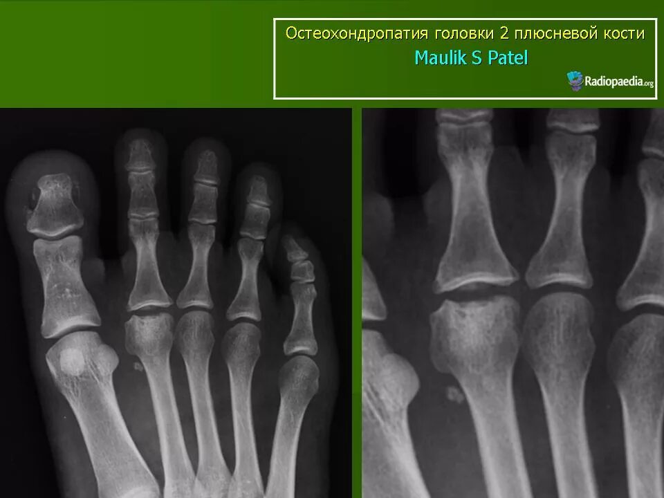 Болезнь Келлера 2 рентген. Остеохондропатия Келлера 2. Остеохондропатия 5 плюсневой кости рентген. Болезнь келлера что это такое