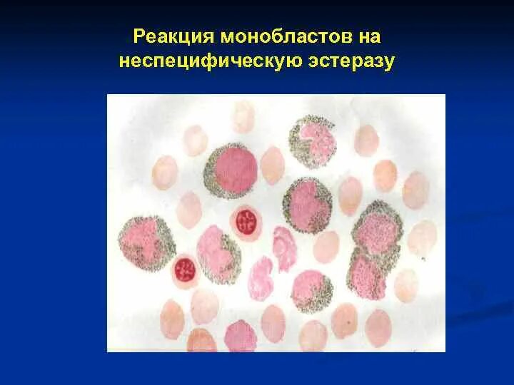 Реакция на лейкоцитарную эстеразу. Реакция на лейкоцитарную эстеразу