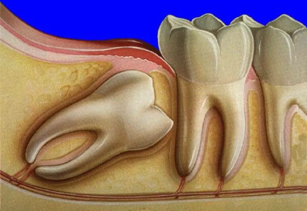 Лечат 8 зуб. Ретинированный зуб мудрости. Ротироваррый зуб мудрости. Ретинированный дистопированный зуб мудрости. Ретинированного дистопированного зуба.
