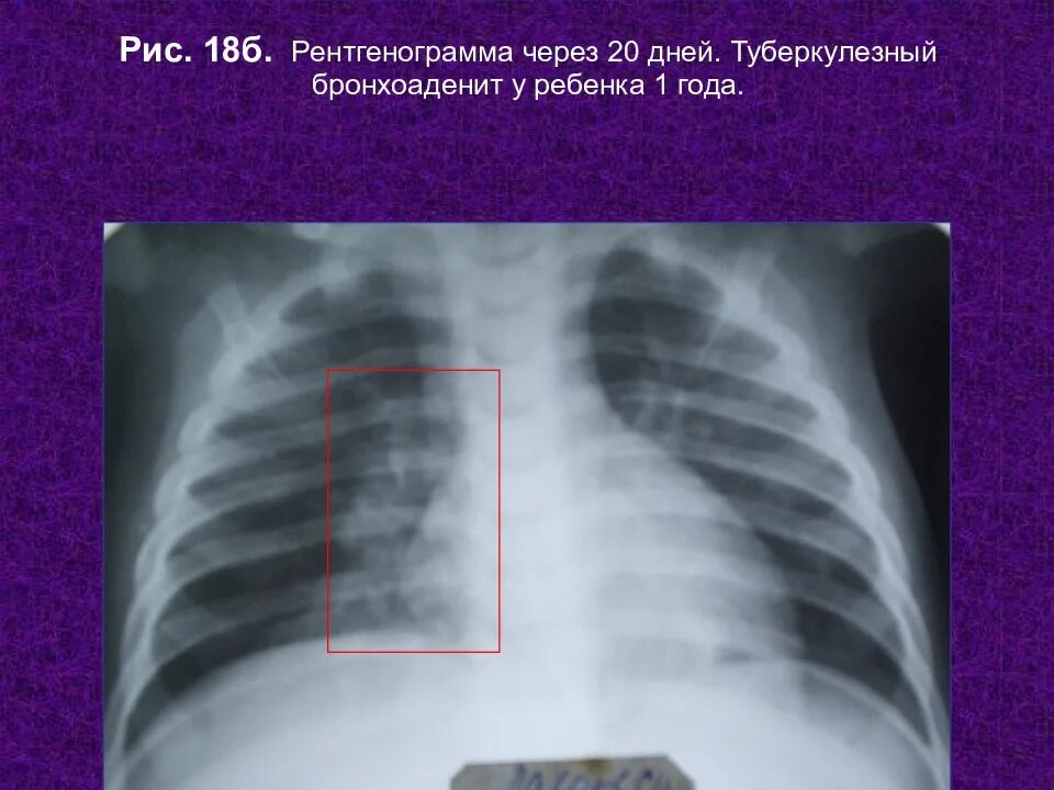 Бронхоаденит это. Инфильтративный бронхоаденит. казеозный бронхоаденит. бронхоаденит у детей на рентгене. туберкулезный бронхоаденит.