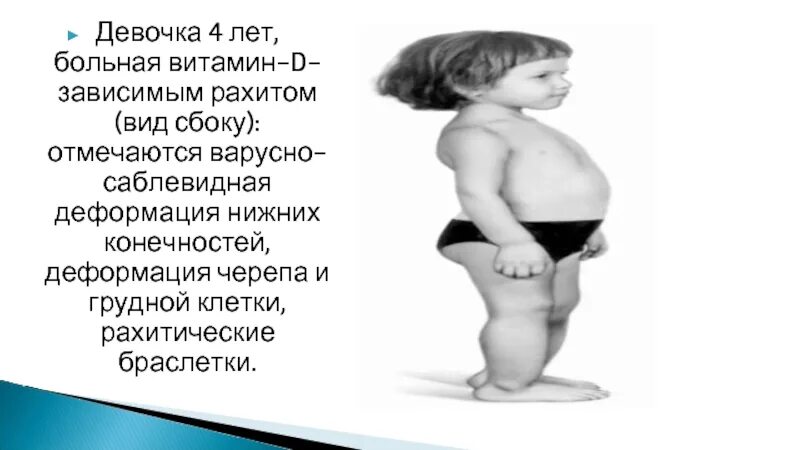 Рахит 6 лет. Рахитоподобные заболевания. рахитоподобные заболевания у детей классификация. витамин d-зависимого рахита. диф диагностика рахита и рахитоподобных заболеваний.