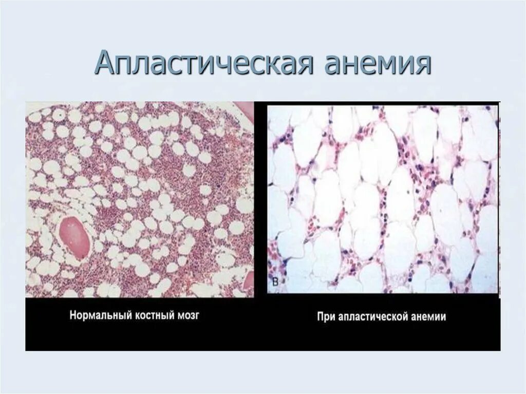 Строение красного и желтого костного мозга. Апластическая анемия клиническая картина. Желтый костный мозг локализован. Угнетение костного мозга. Причины апластической анемии.