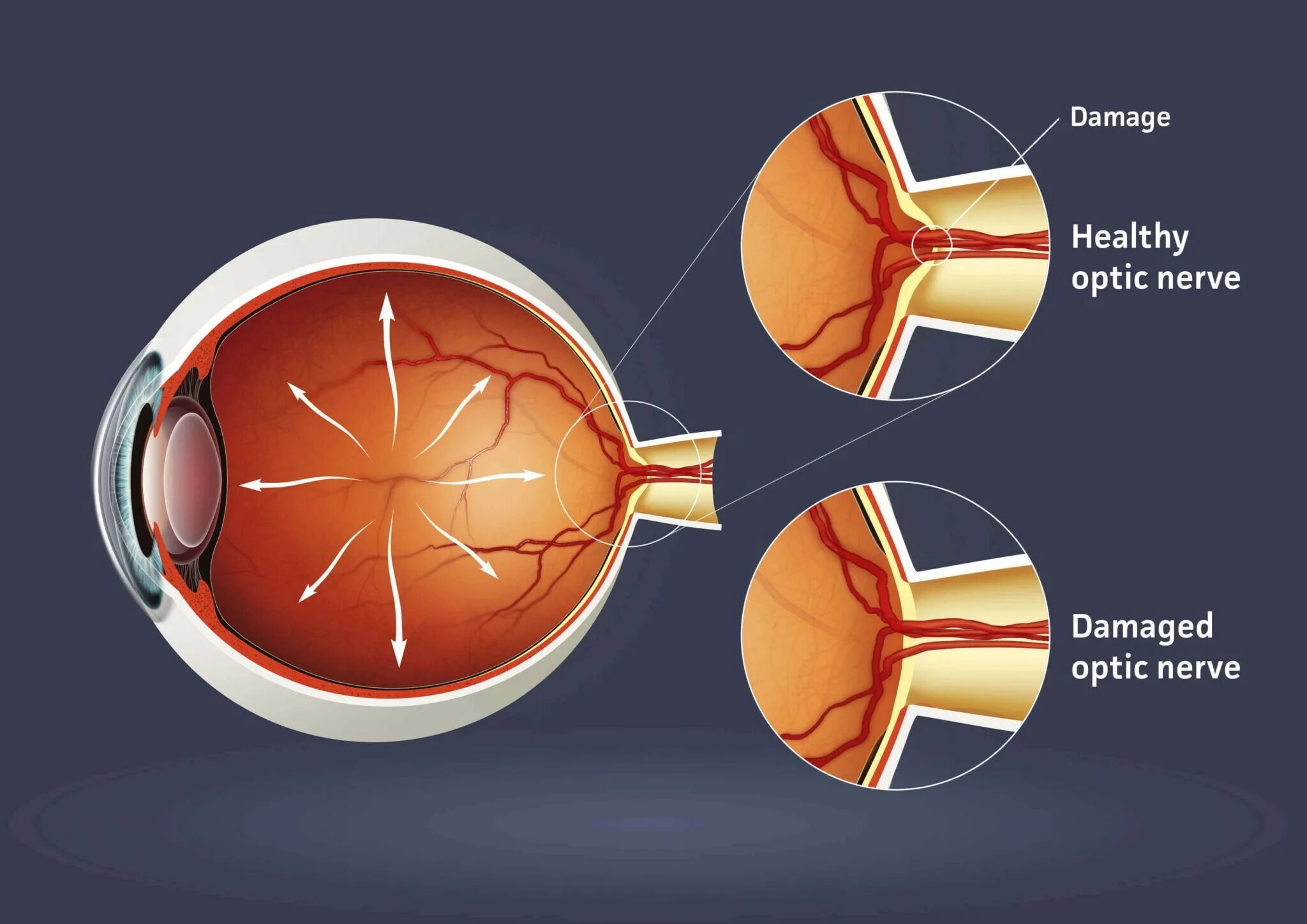 Зрительный нерв глаукома. Глаукома миопического глаза. Кольцевидная глаукома.