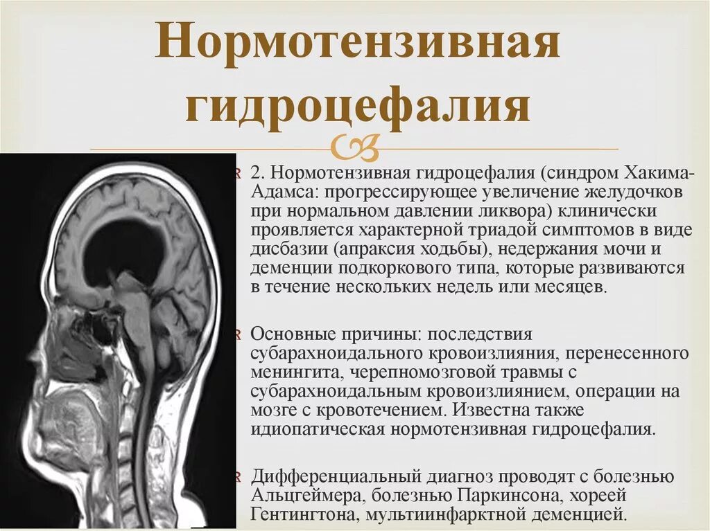 Синдром Хакима-Адамса нормотензивная гидроцефалия. Нормотензивная гидроцефалия мрт. Наружная гидроцефалия головного мозга. Нормотензивная гидроцефалия кт.