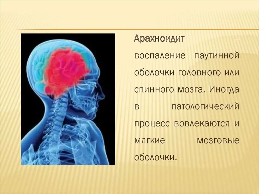 Воспаление паутинной мозговой оболочки. Базилярный арахноидит. Кистозный арахноидит. Церебральный арахноидит. Воспаление головного мозга латынь