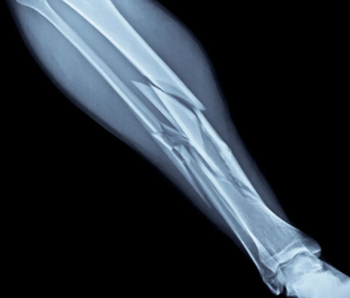 A fracture is a broken bone